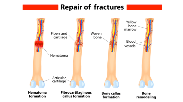 Surgical and fracture repair codes in the musculoskeletal subsection